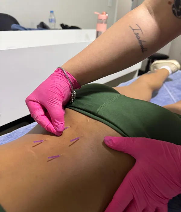 Curso de Dry Needling presencial em Maringá — prática supervisionada de agulhamento a seco