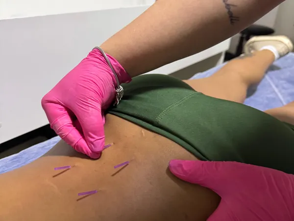 Curso de Dry Needling presencial em Maringá — prática supervisionada de agulhamento a seco